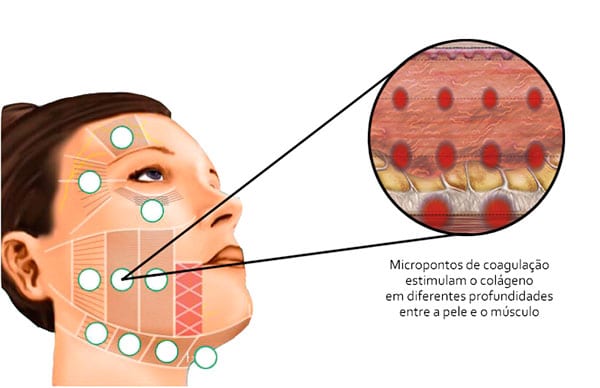 liftera-como-funciona-ultrassom-microfocado