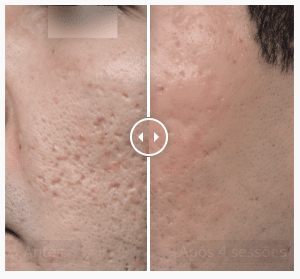 Antes-e-Depois-Laser-para-cicatrizes