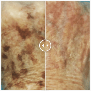 Antes-e-Depois-Laser-para-manchas