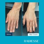 Antes-e-depois-Radiesse-Foto