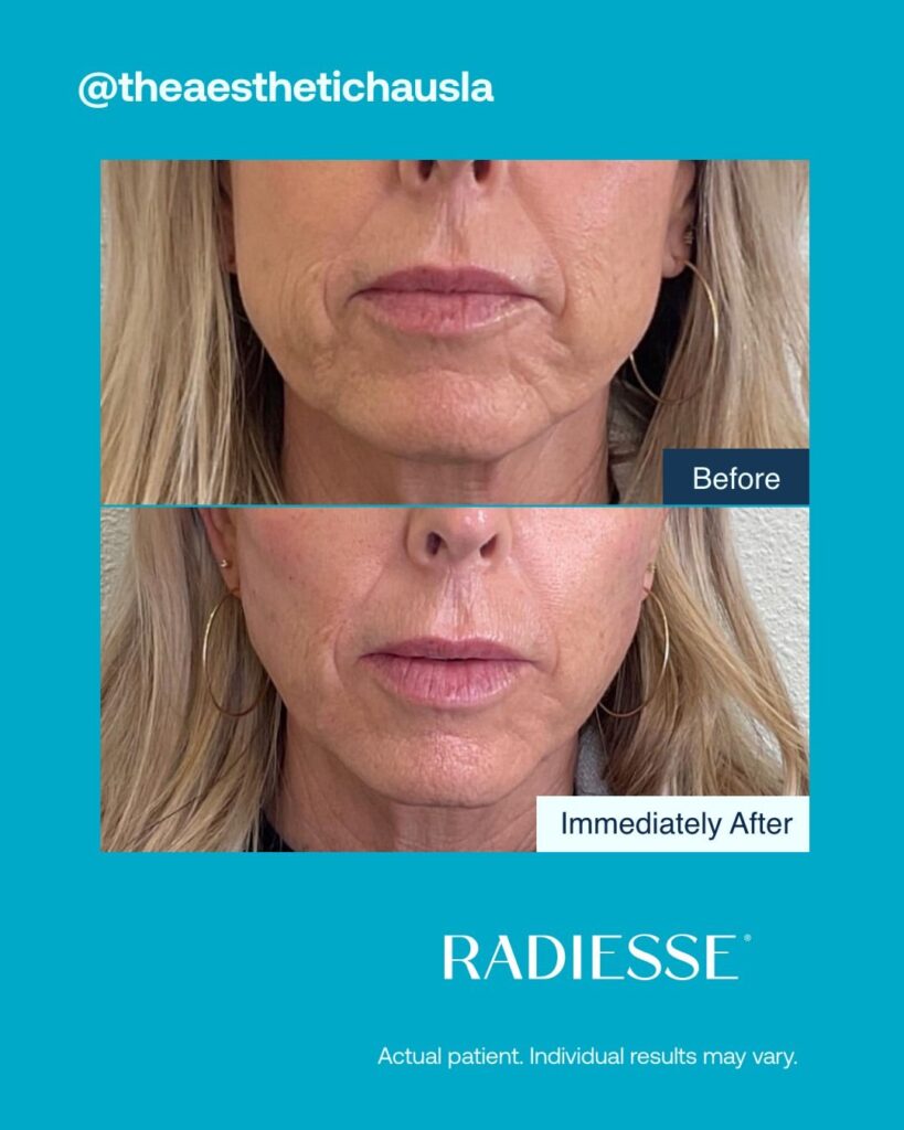 Antes-e-depois-Radiesse-Foto