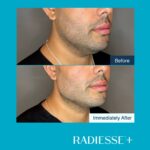 Antes-e-depois-Radiesse-Foto