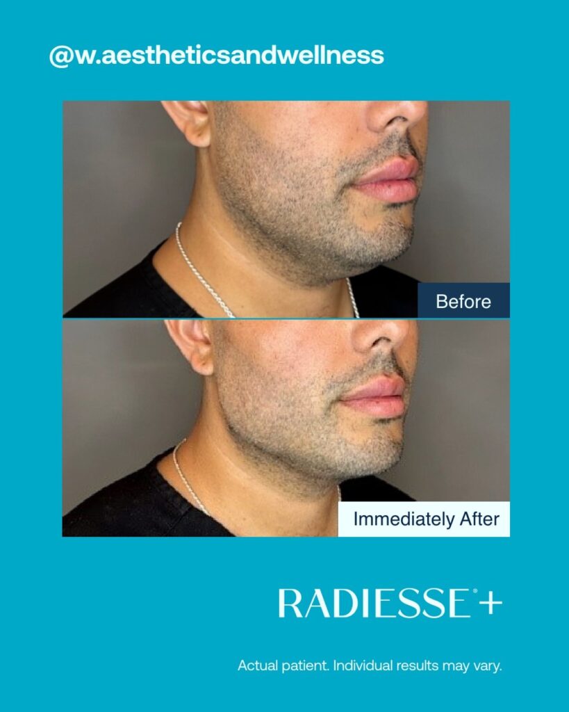 Antes-e-depois-Radiesse-Foto