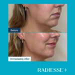Antes-e-depois-Radiesse-Foto