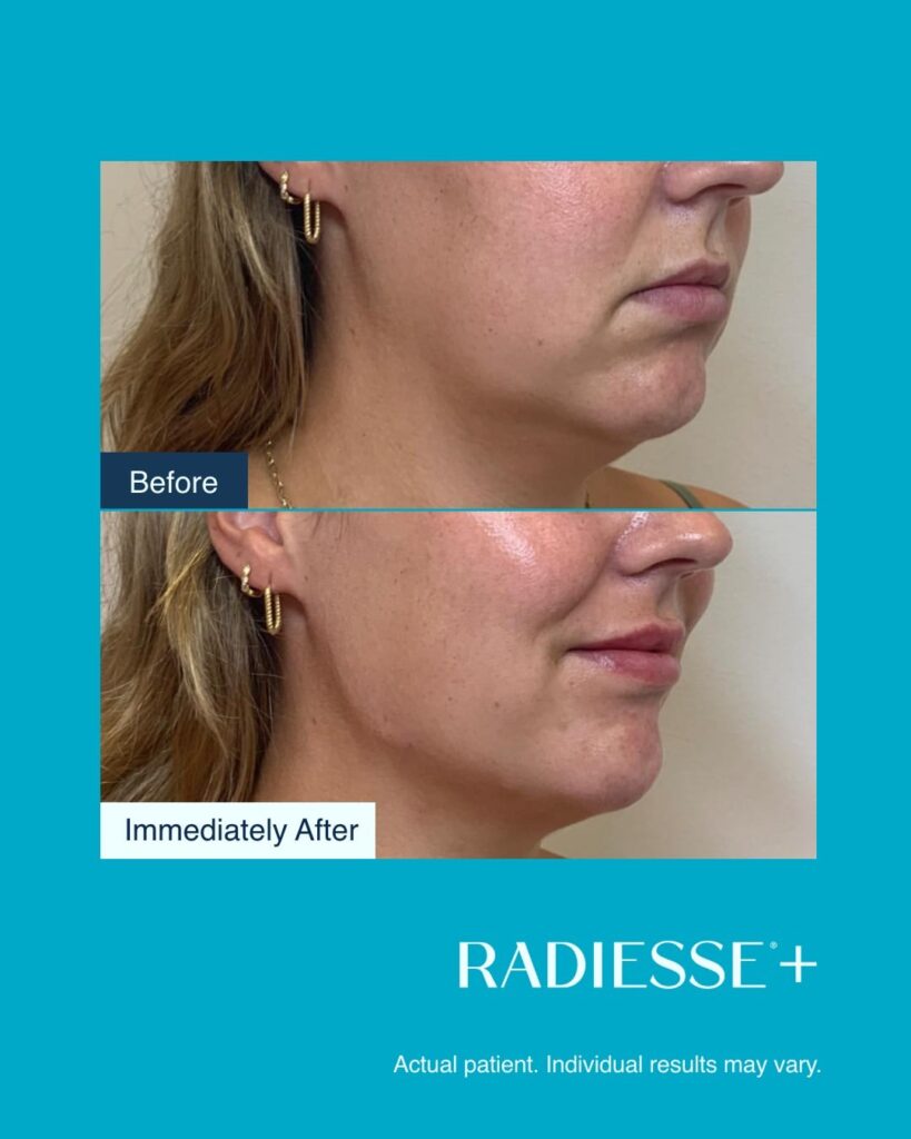 Antes-e-depois-Radiesse-Foto