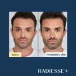 Antes-e-depois-Radiesse-Foto
