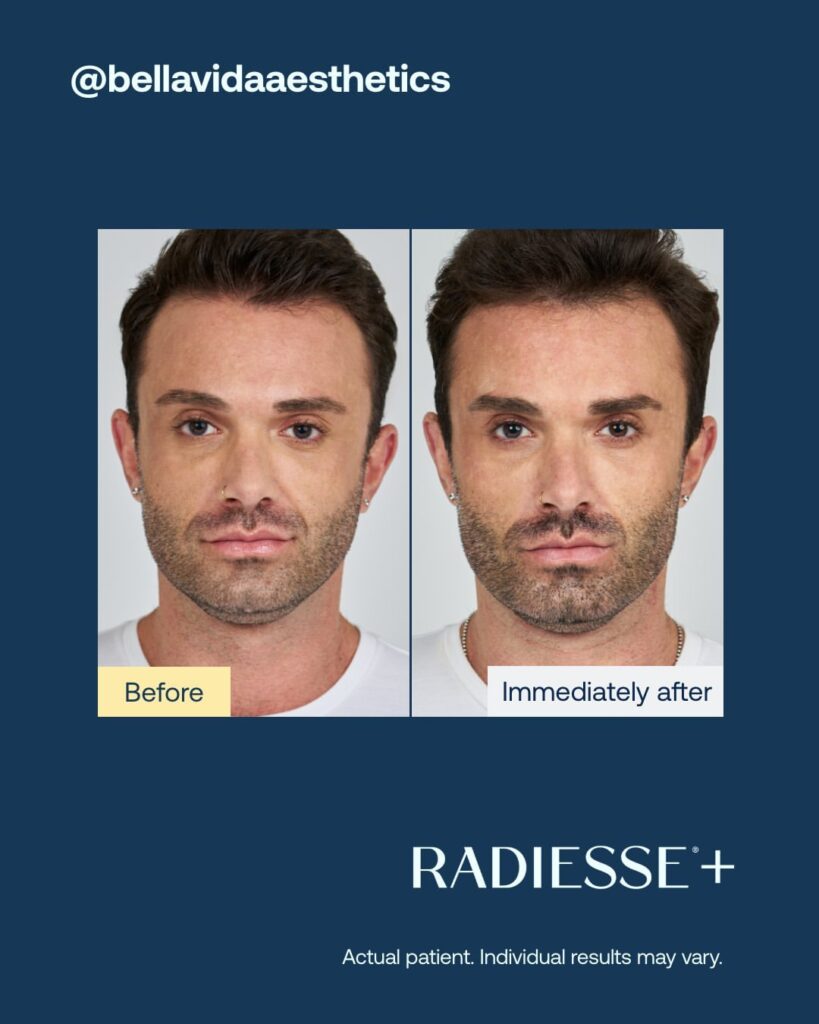 Antes-e-depois-Radiesse-Foto