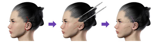 Lifting-facial-tecnicas2