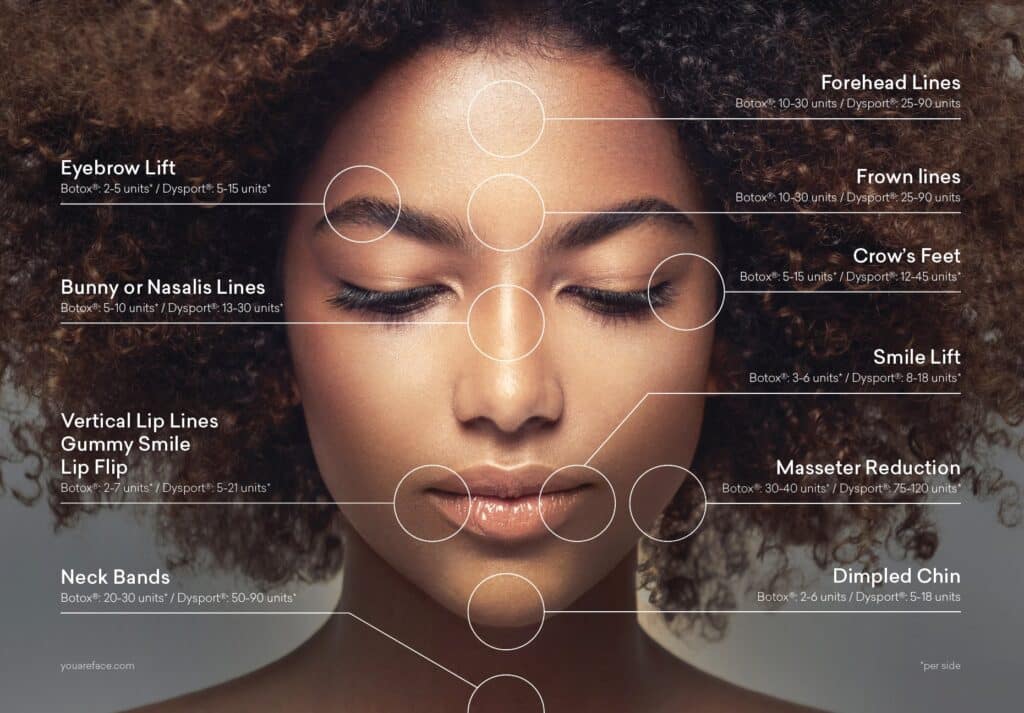 face_diagram_BOTOX