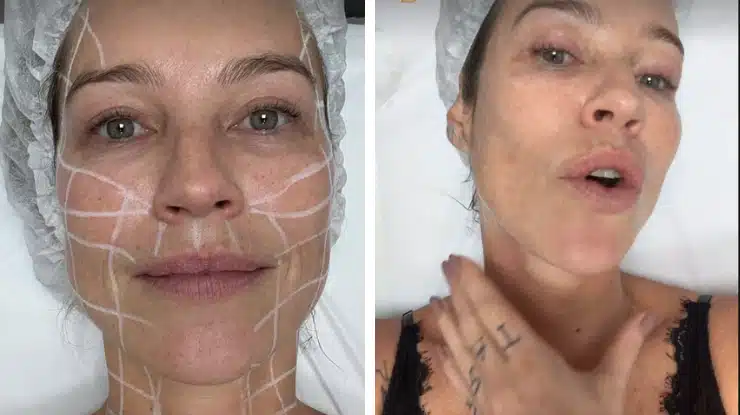 luana-piovani-procedimento-estetico
