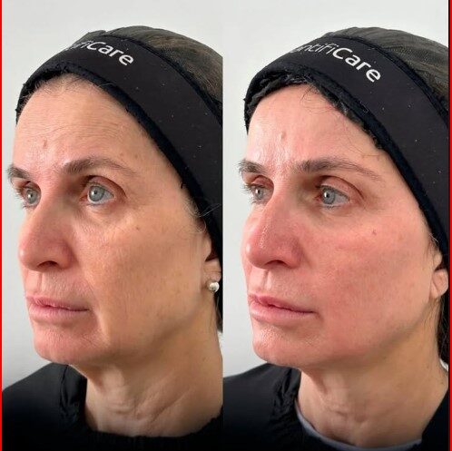 coolfase-antes-depois