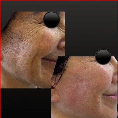 coolfase-antes-depois