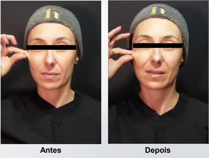 coolfase-antes-depois