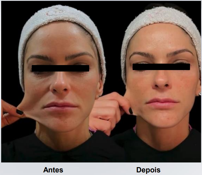 coolfase-antes-depois