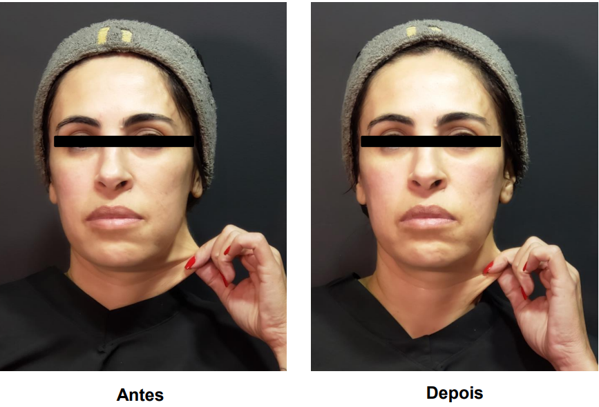 coolfase-antes-depois