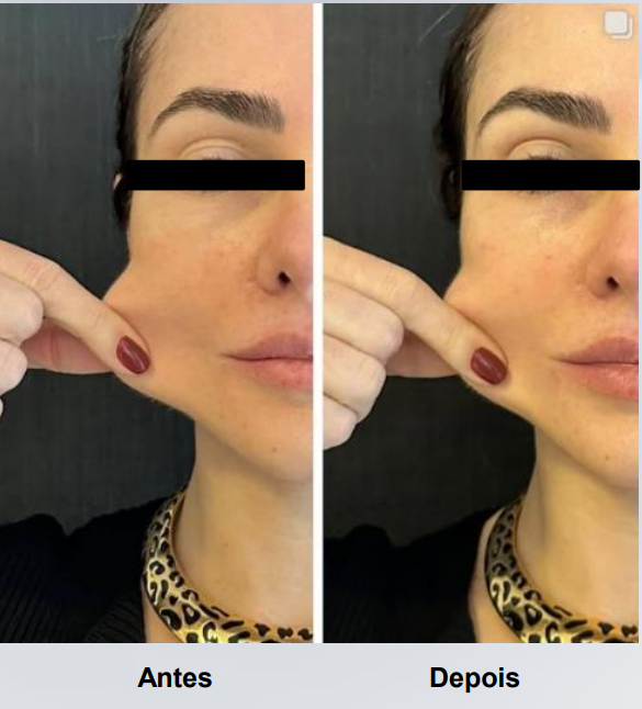 coolfase-antes-depois