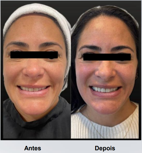 coolfase-antes-depois