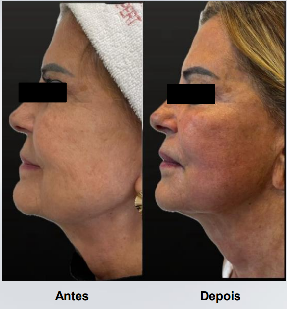 coolfase-antes-depois