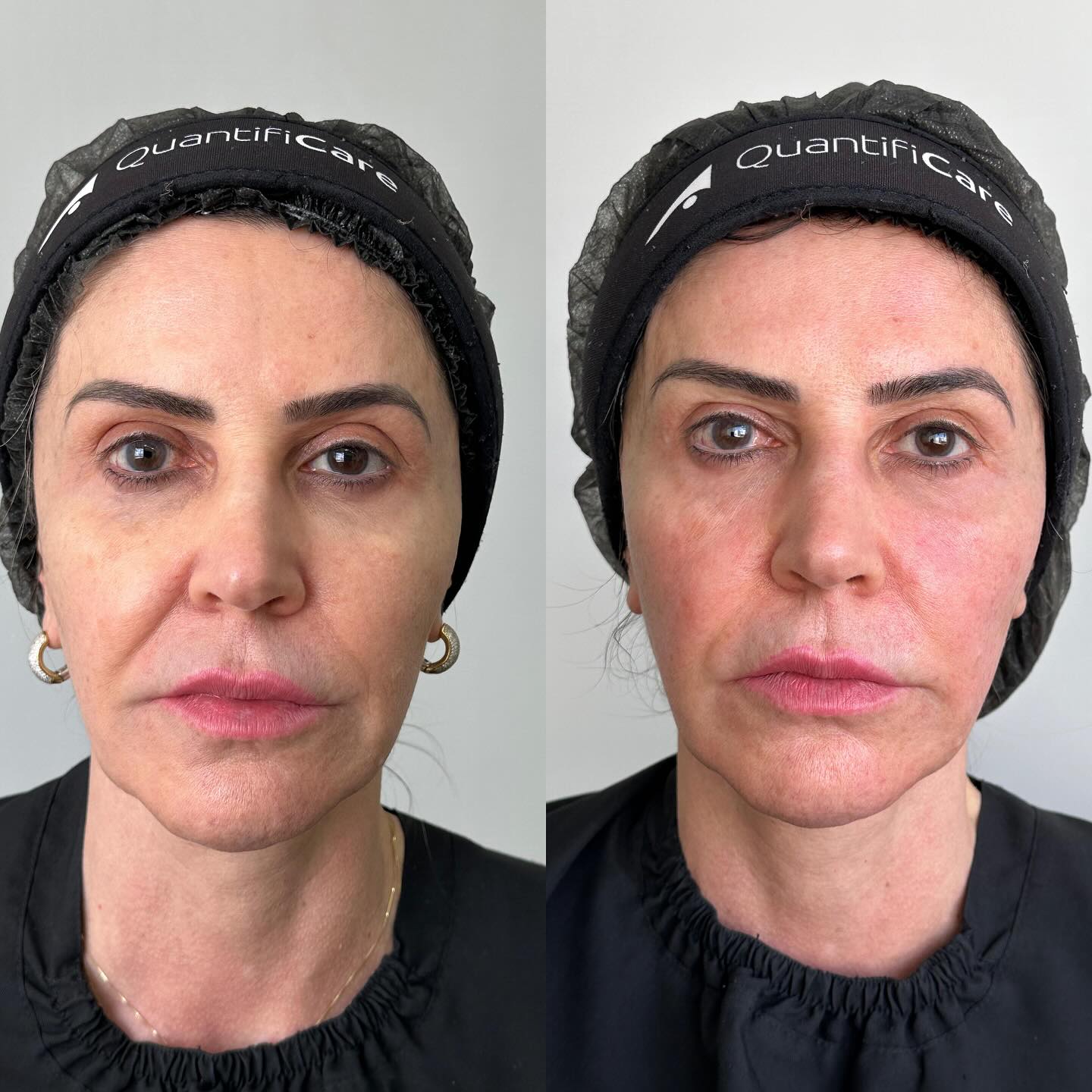 coolfase-antes-depois