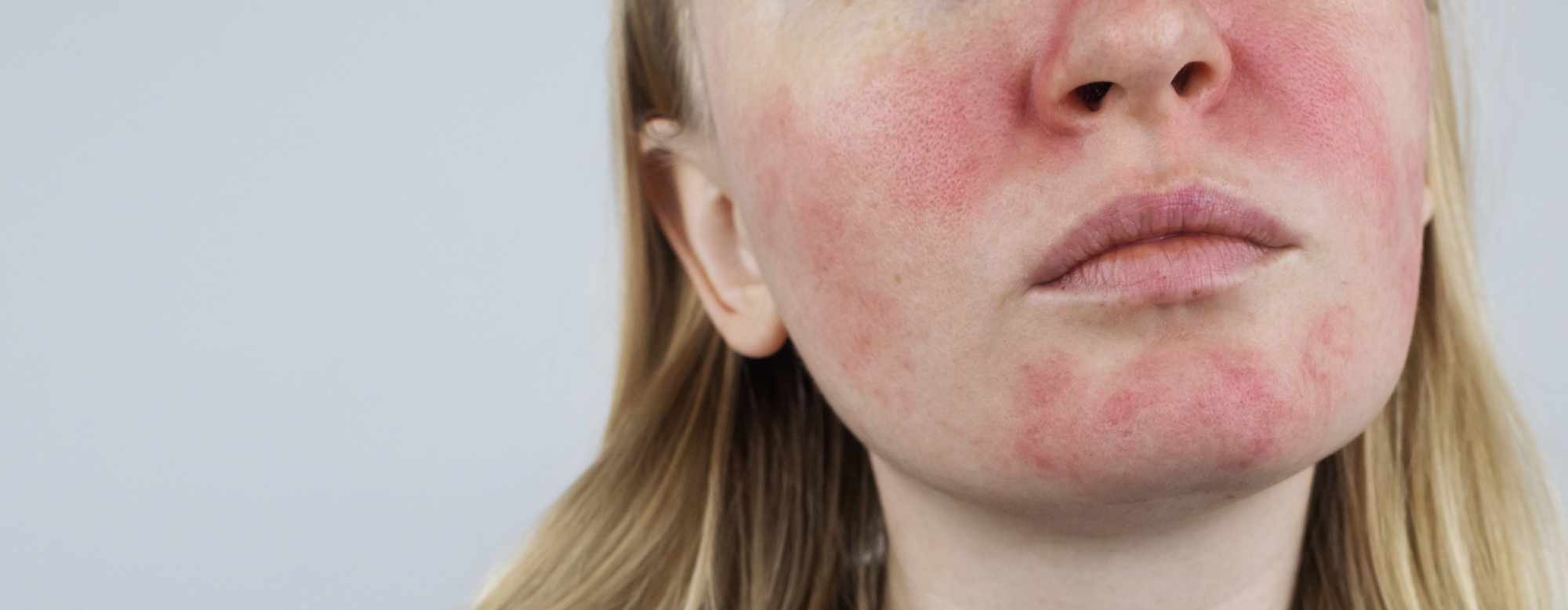 rosacea-tratamento