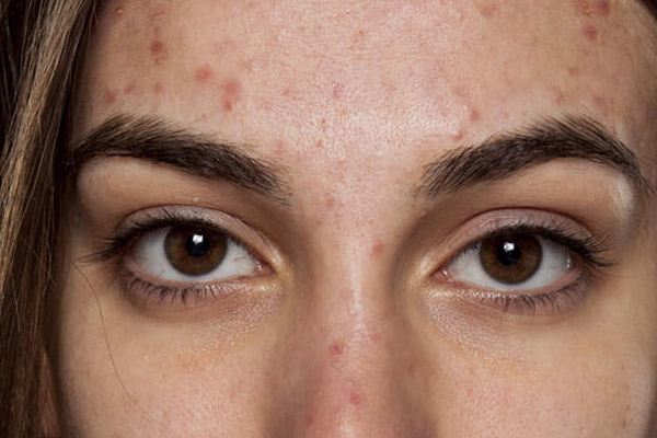 manchas-de-espinhas-e-acne