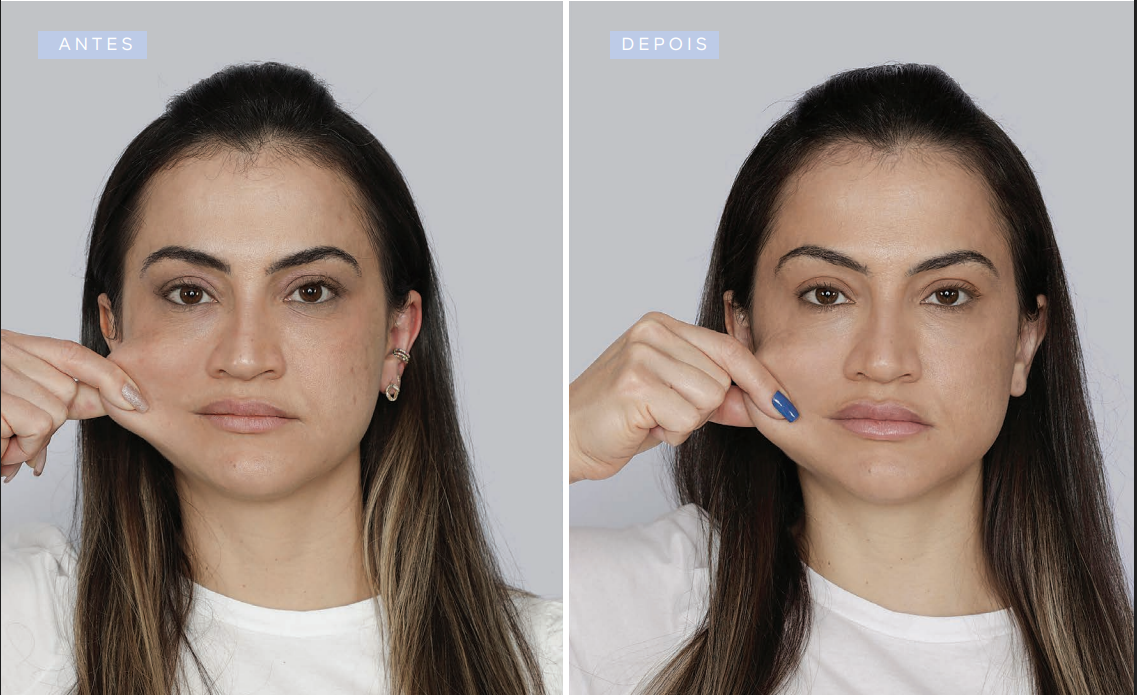 antes-e-depois-sculptra