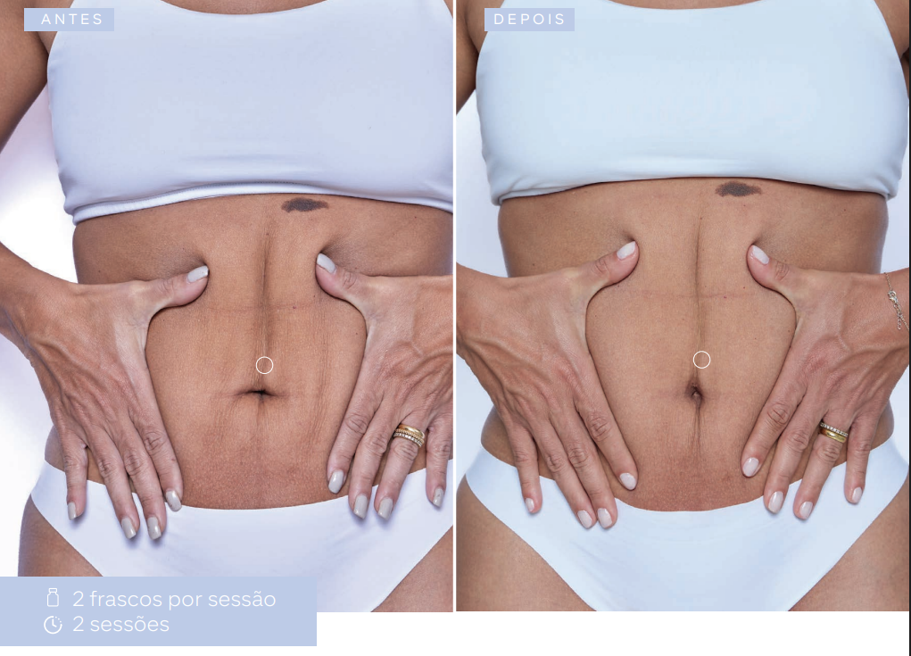 antes-e-depois-sculptra
