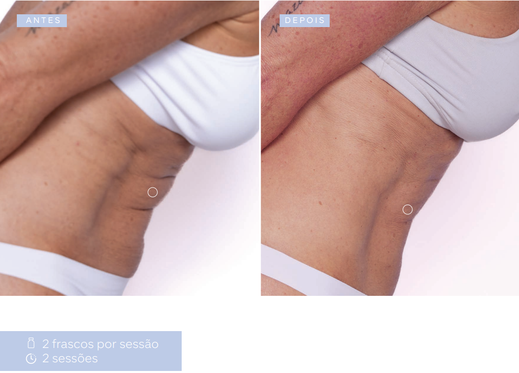 antes-e-depois-sculptra