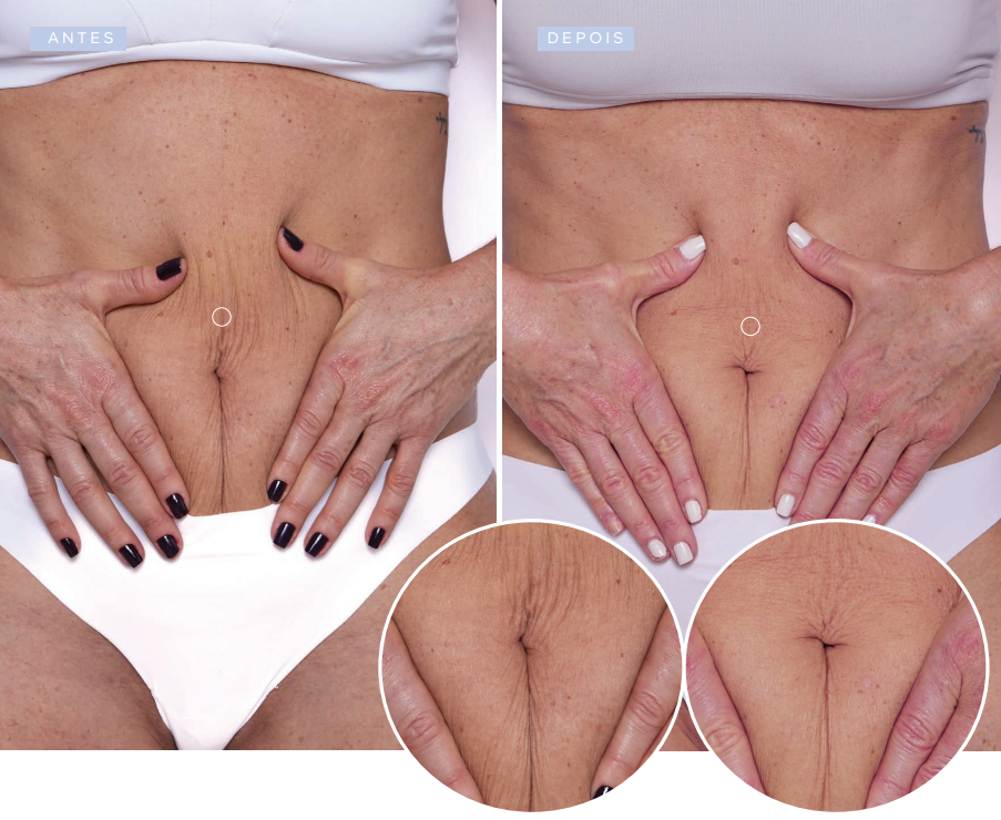 antes-e-depois-sculptra