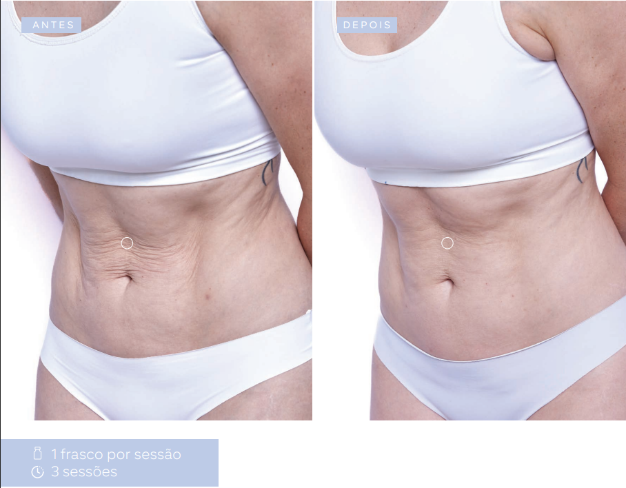 antes-e-depois-sculptra
