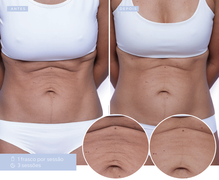 antes-e-depois-sculptra