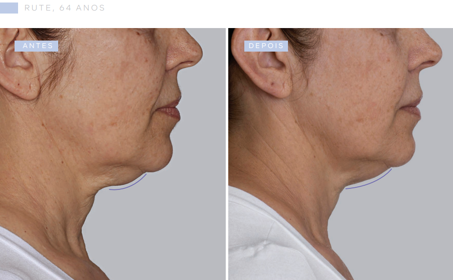 antes-e-depois-sculptra
