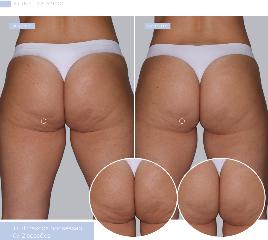 antes-e-depois-sculptra