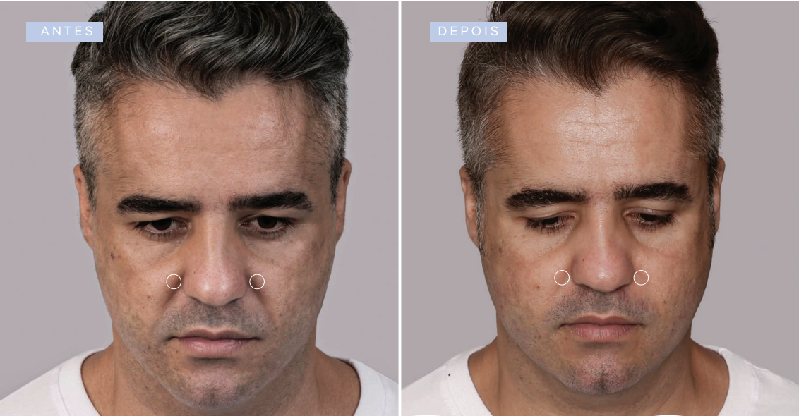 antes-e-depois-sculptra
