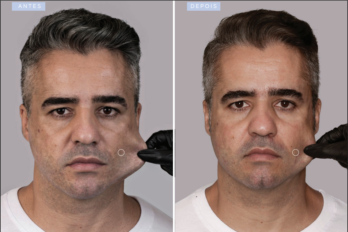 antes-e-depois-sculptra