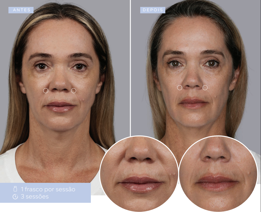 antes-e-depois-sculptra