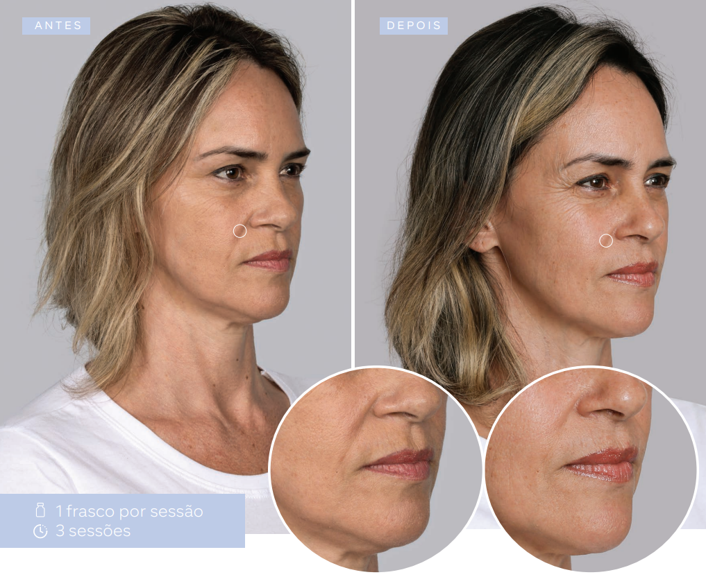 antes-e-depois-sculptra