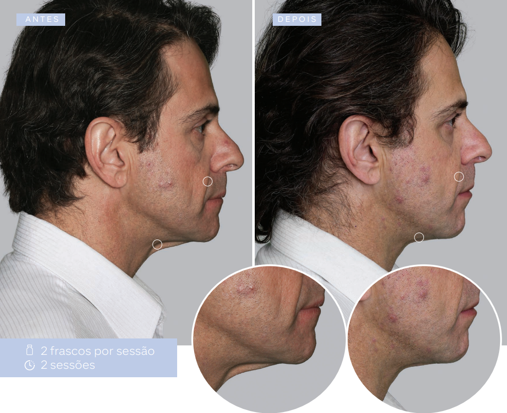 antes-e-depois-sculptra