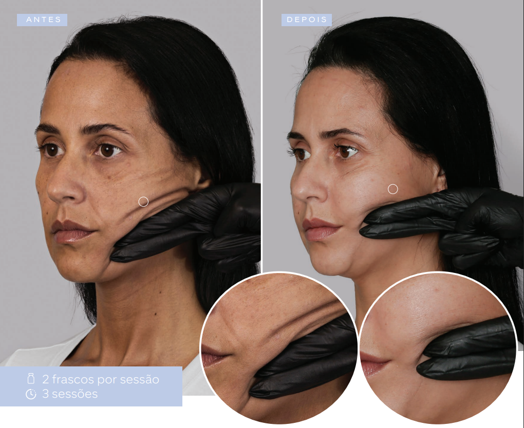 antes-e-depois-sculptra