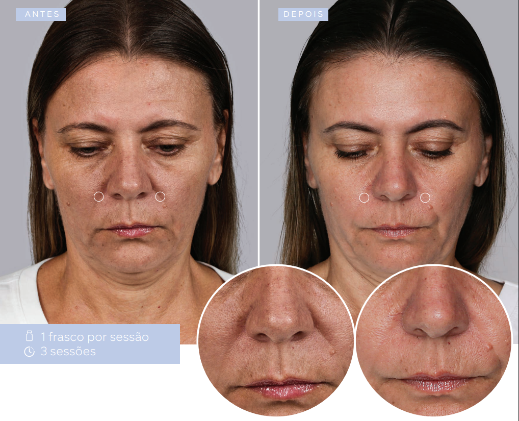 antes-e-depois-sculptra