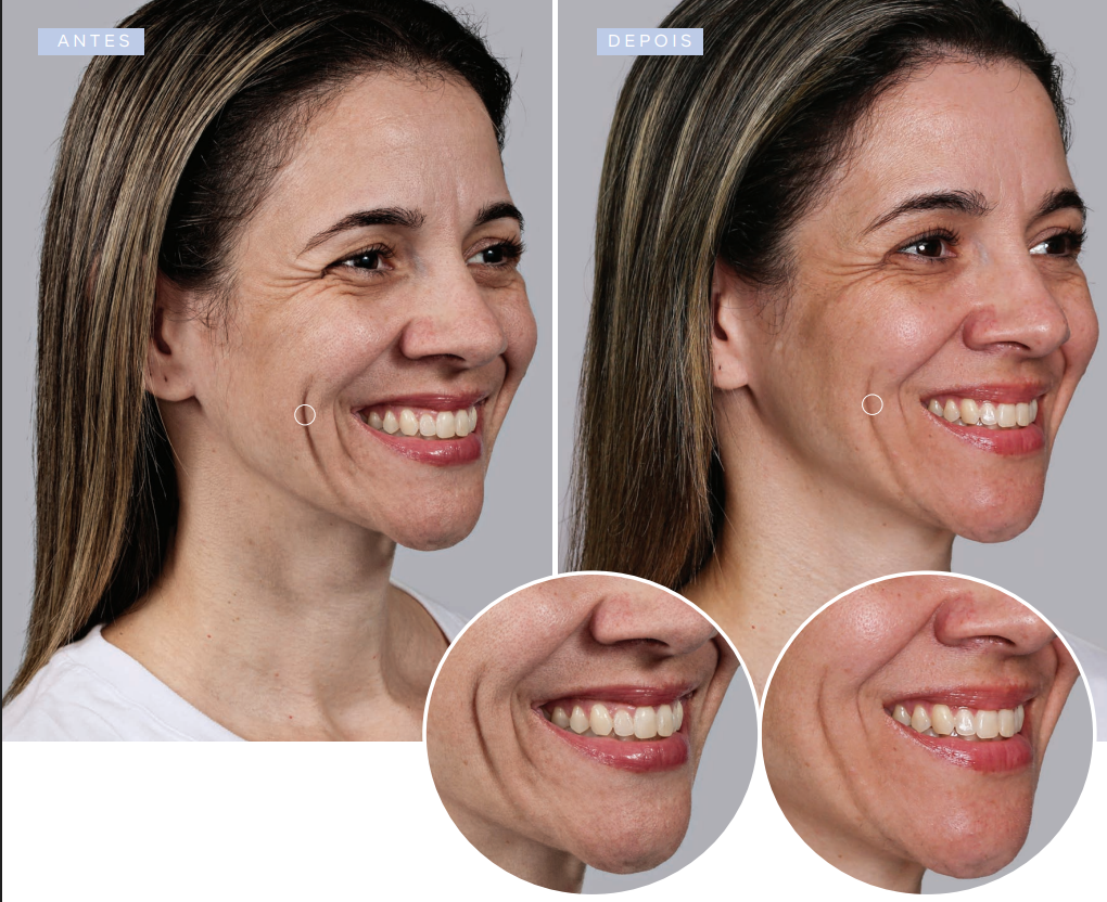 antes-e-depois-sculptra