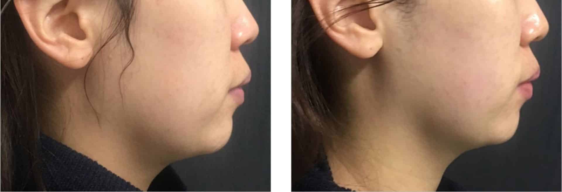 liftera-antes-e-depois