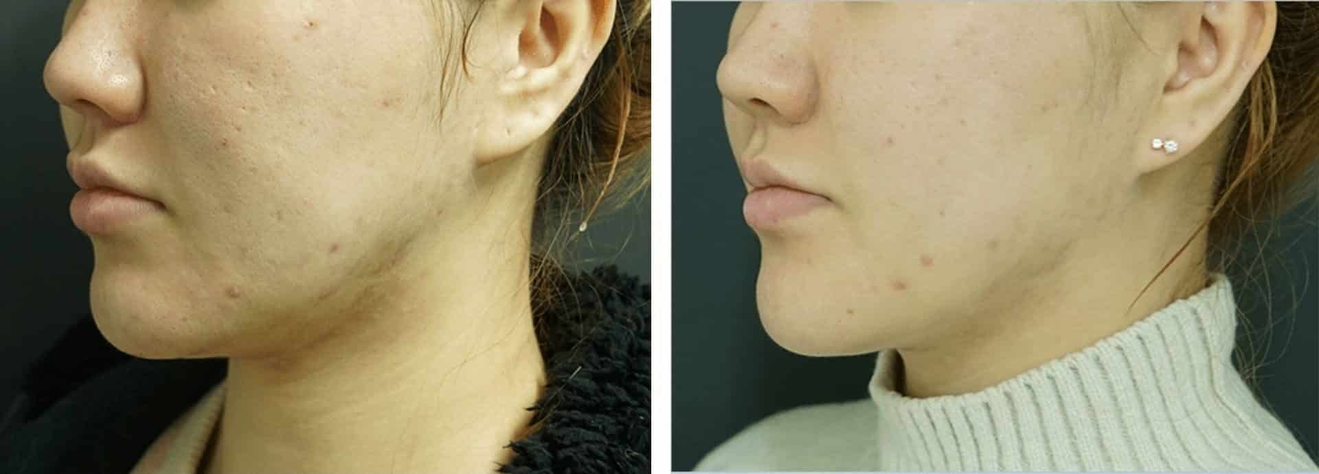 liftera-antes-e-depois