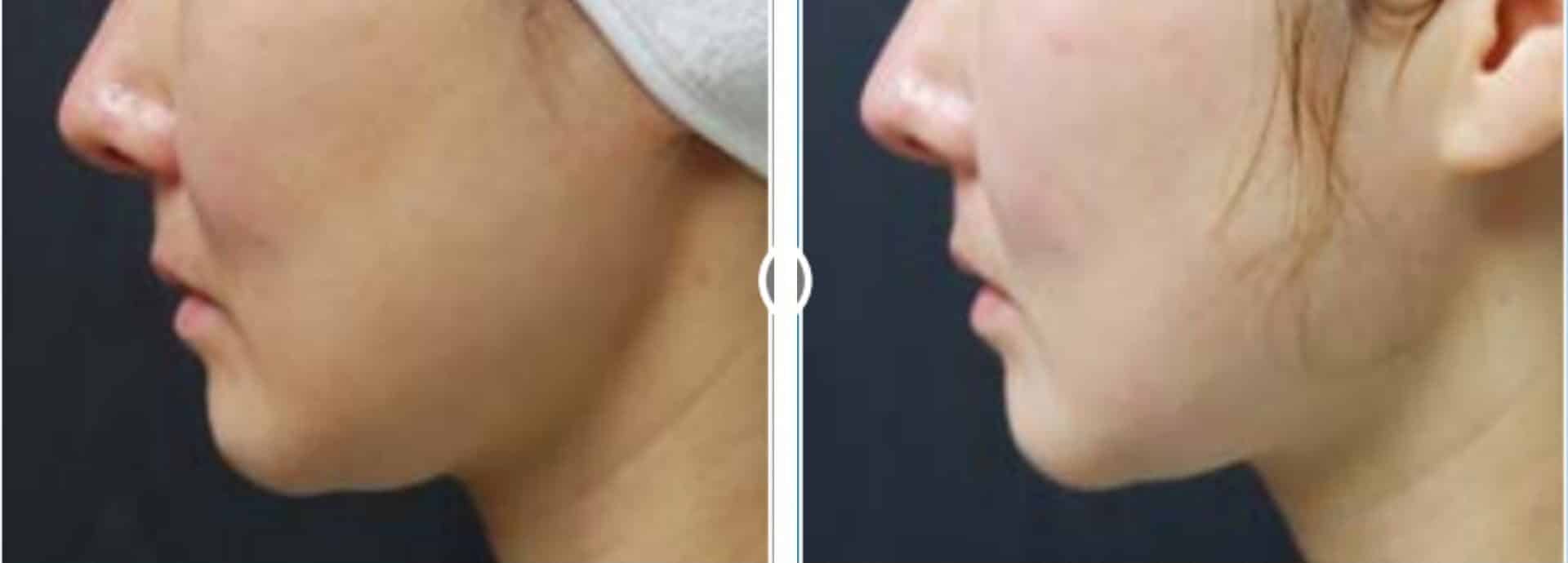 liftera-antes-e-depois