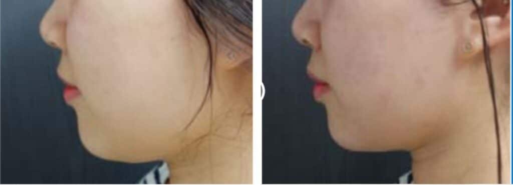 liftera-antes-e-depois