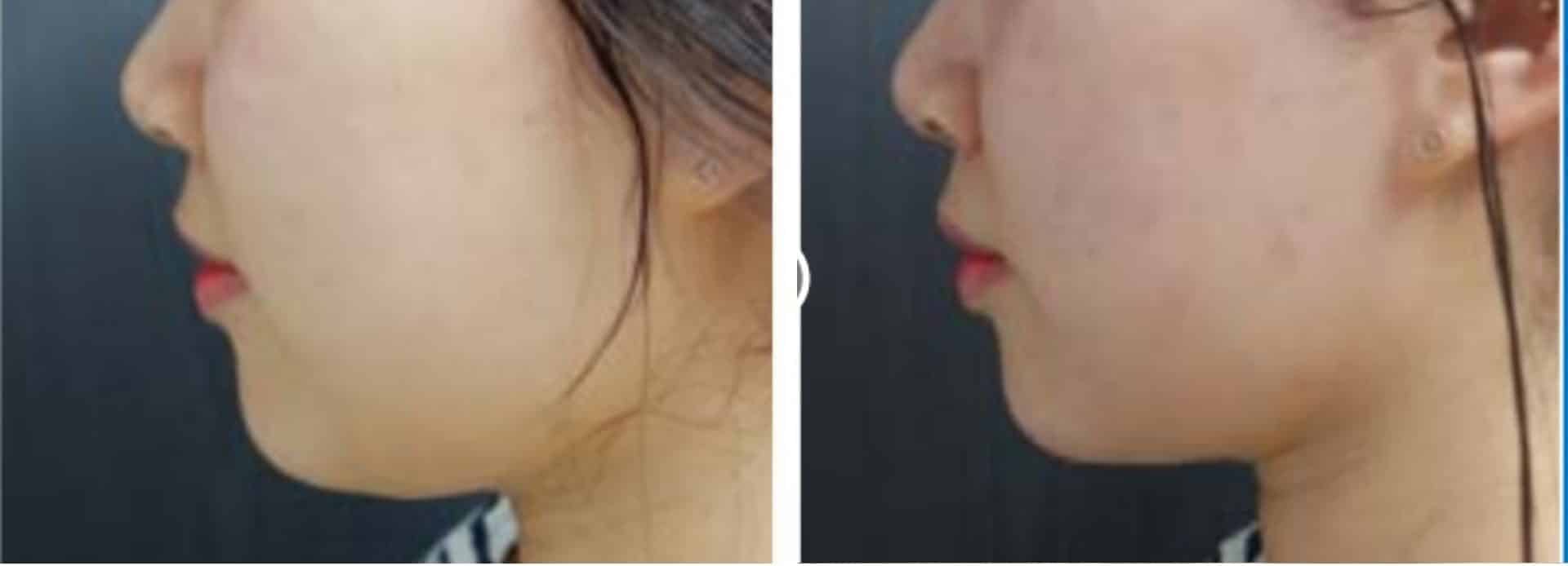 liftera-antes-e-depois