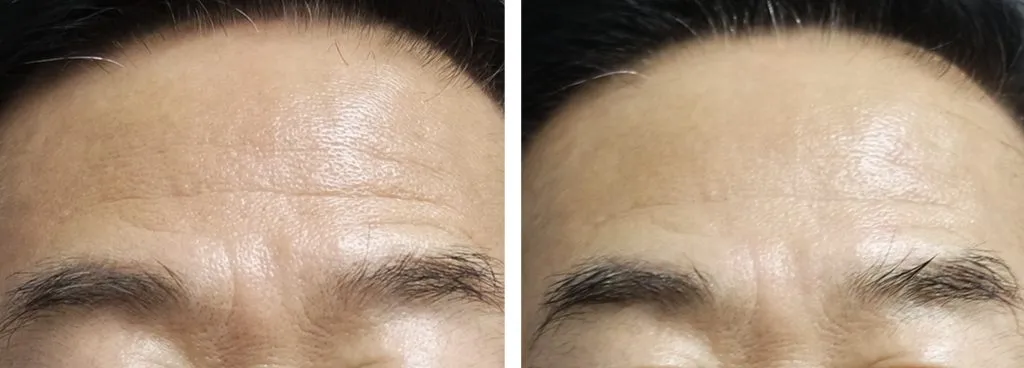 liftera-antes-e-depois