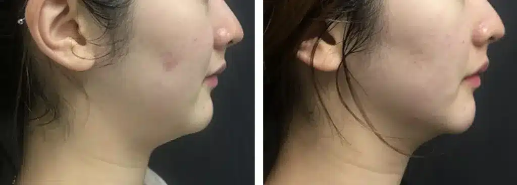 liftera-antes-e-depois