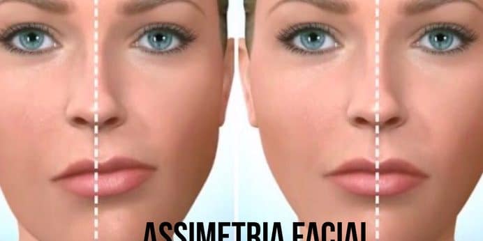 ultraformer-rosto-torto