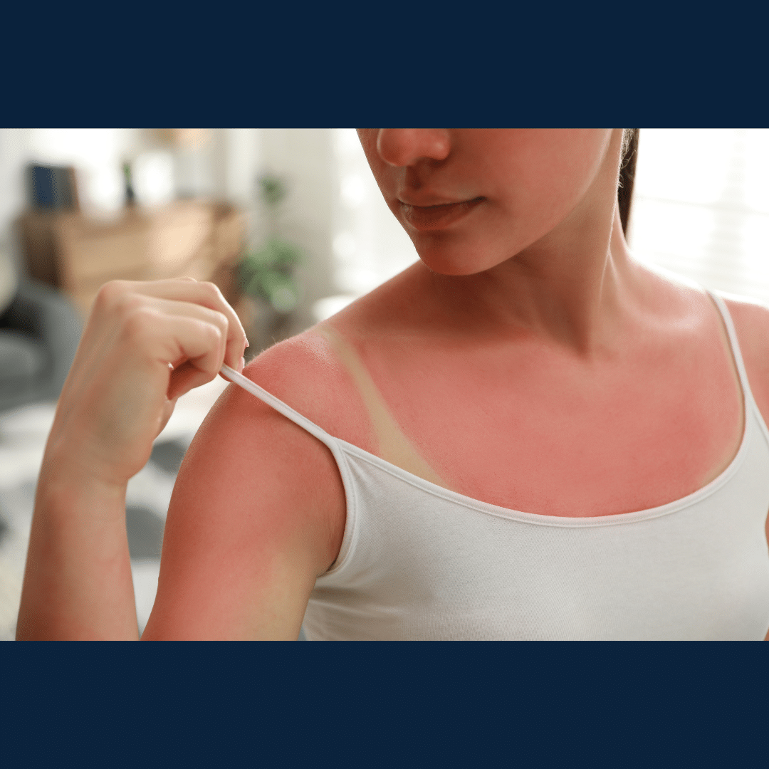 aliviar-queimadura-de-sol